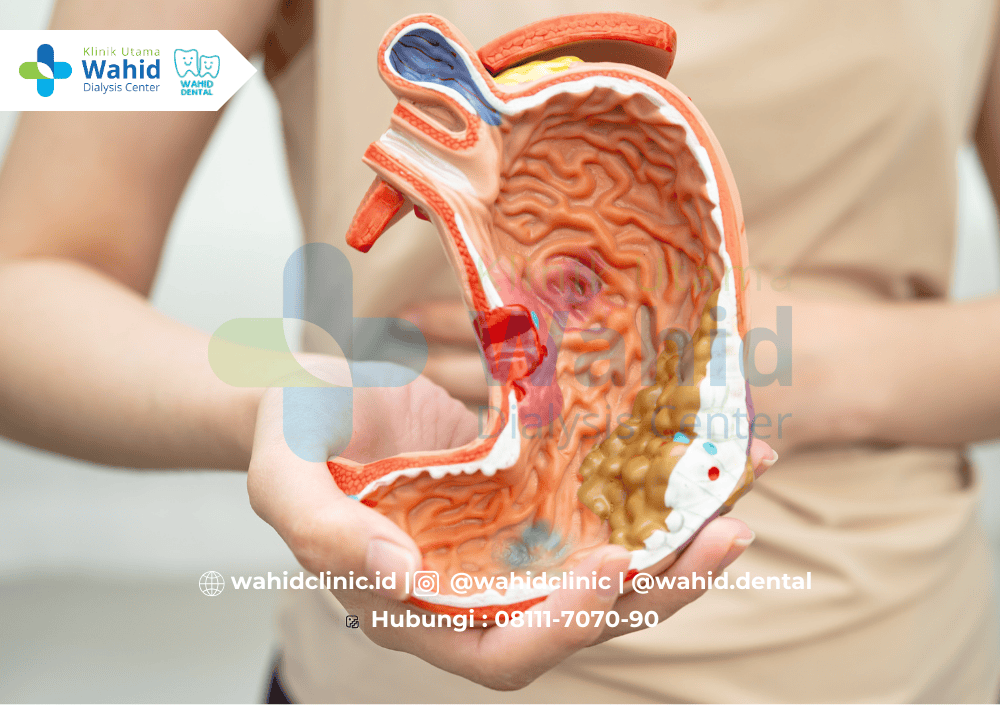 Perbedaan Sakit Maag Biasa dan GERD yang Perlu Anda Tahu