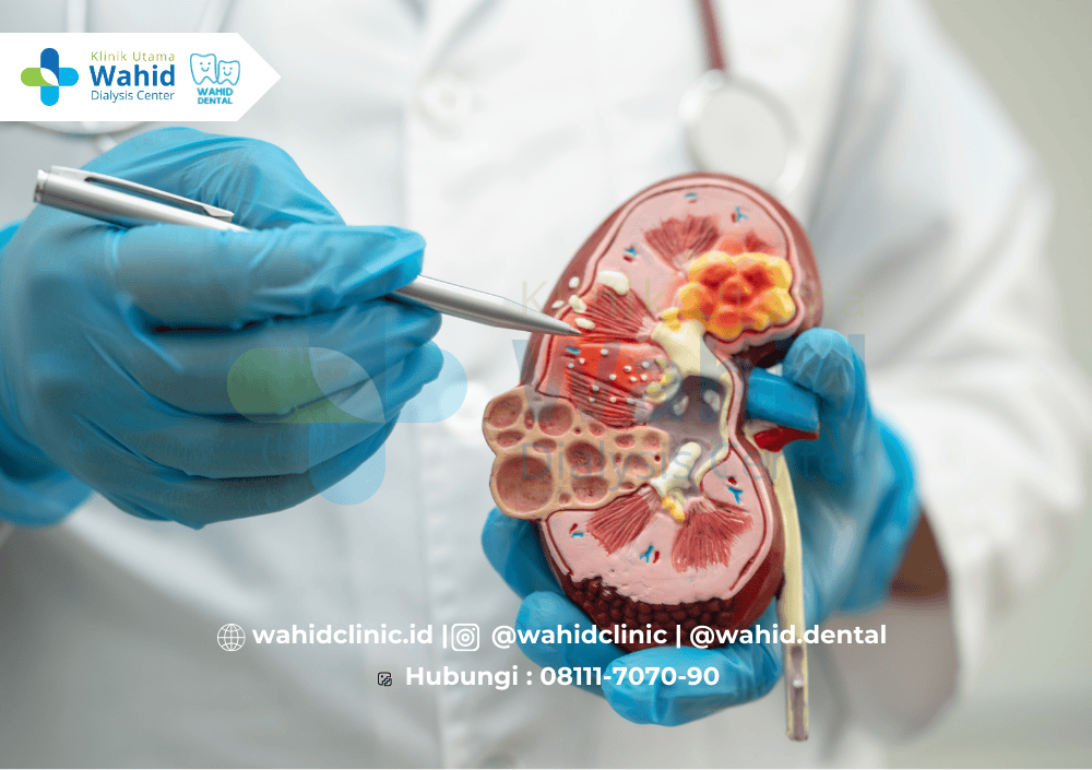 5 Komplikasi Gagal Ginjal yang Bisa Dicegah dengan Hemodialisa Rutin
