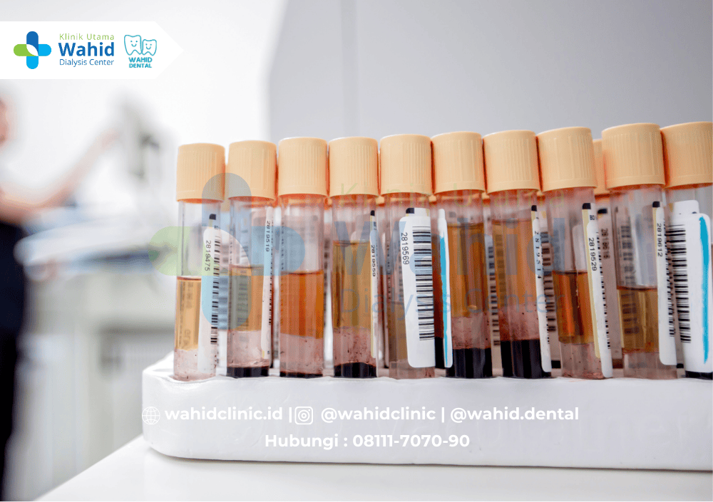 Tes CRP (C-Reactive Protein) sebagai Penanda Inflamasi